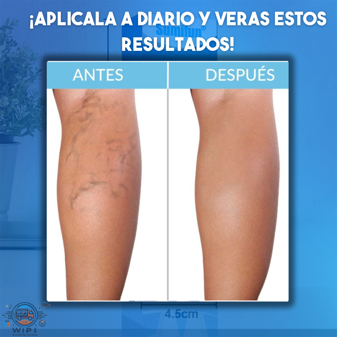 ¡Despídete de las Várices con VeinAway Cream!